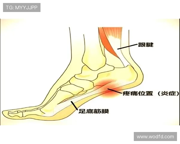 足底筋膜炎从成因症状到康复训练与日常预防的科学指南详解实用版